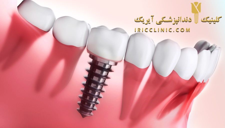 بهترین روش کاشت دندان (هزینه ایمپلنت دندانپزشکی آیریک)