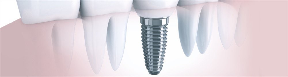 بخش اصلی ایمپلنت یک پایه فلزی تیتانیومی است که به جای ریشه دندان طبیعی قرار می گیرد