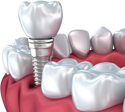 برای ساختن تاج دندان مصنوعی ثابت جدید، از شکل، رنگ، دندان های طبیعی فرد به عنوان الگو استفاده می شود