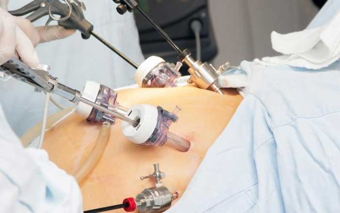 عمل بای پس معده چگونه انجام می‌شود؟