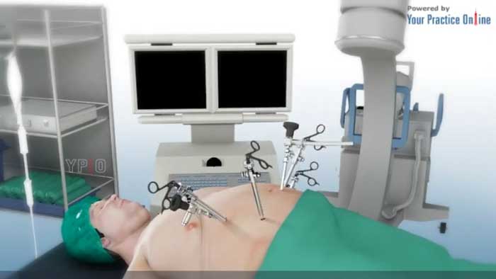 در طول روند بای پس چه اتفاقی می افتد؟